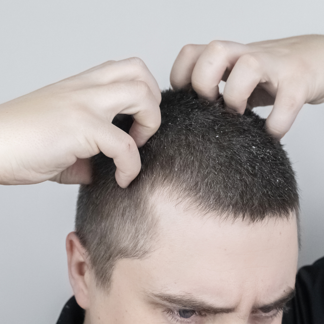 Itchy Scalp Shampoo & Treatments | Stim Hair